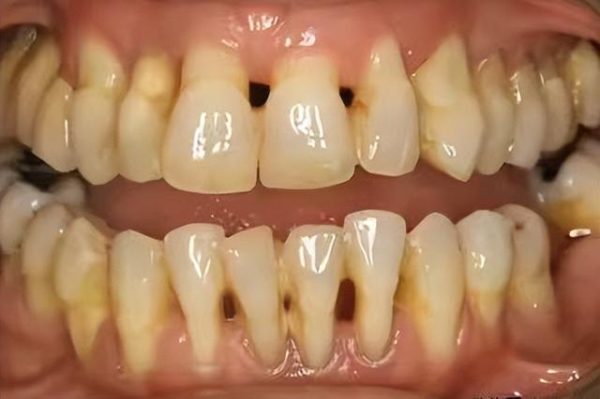 為何牙周病？牙周病怎麼傷害牙齒？該如何預防牙周病？