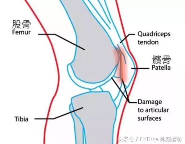 蹲下就膝蓋痛是什麼情況？需要注意什麼？怎麼緩解？