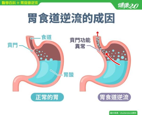 胃食道逆流的原因？常見胃食道逆流的類型？該怎麼緩解、預防及治療？