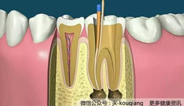 什麼是根管治療？根管治療後常見問題？根管治療有風險嗎?