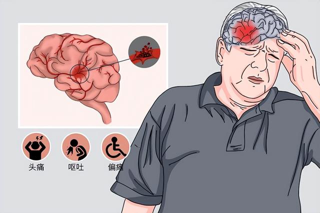 高血壓患者在哪些情況下容易發生腦出血